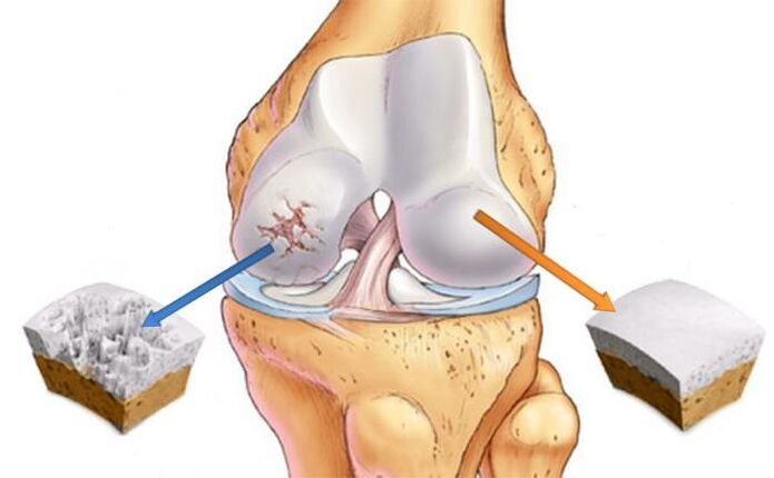 Mi az arthrosis