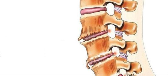Mi a spondylosis