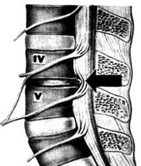 X -G -Kép az Osteochondrosis Lumbar Tanszékről