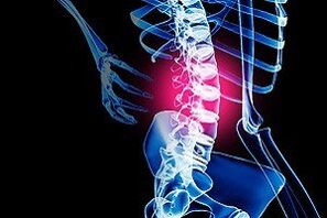 az ágyéki gerinc osteochondrosisa