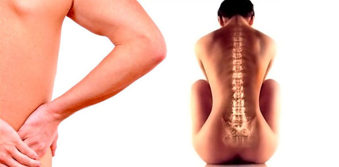 osteochondrosis okozta derékfájás