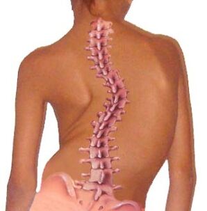 A gerinc görbülete osteochondrosishoz vezet