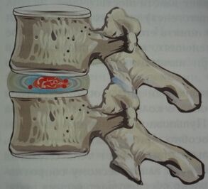 Az osteochondrosis első szakasza