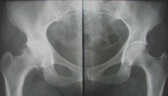 az érintett csípőízület röntgenfelvétele arthrosissal